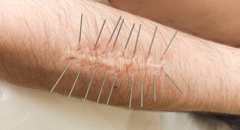 Akupunktura blizn